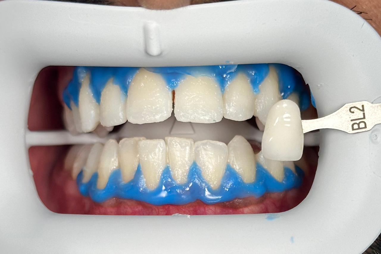 after whitening led at kanou dental