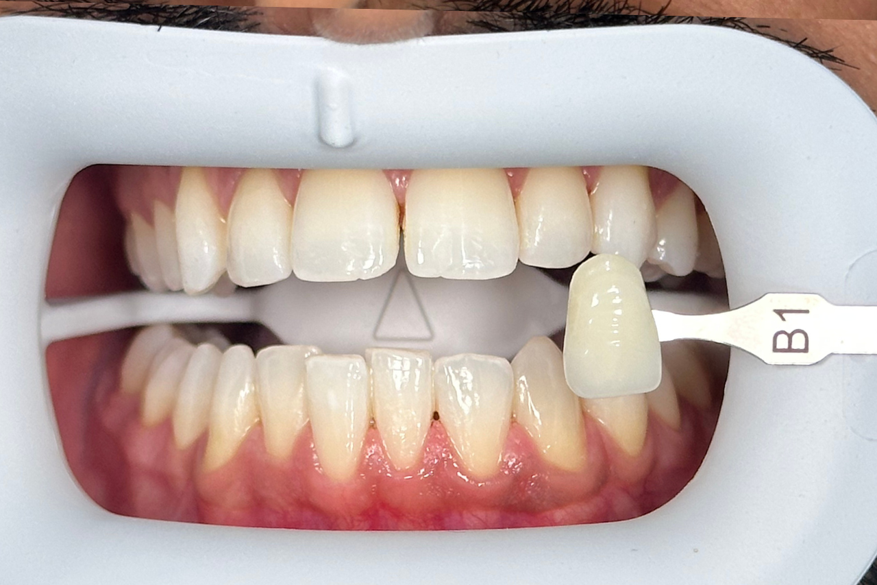 Before Whitening LED AN Before whitening led at kanou dental