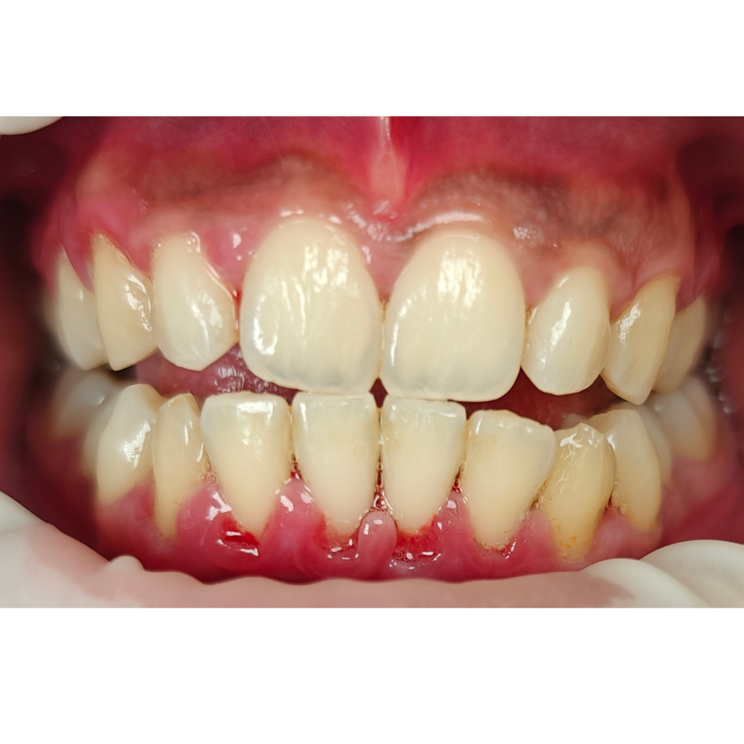 dental cleaning after c