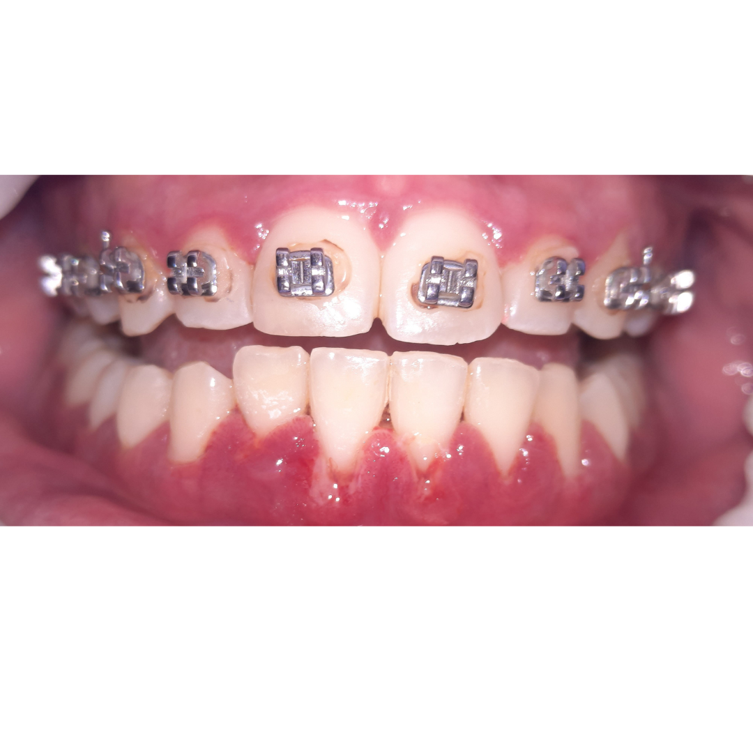 dental cleaning after d