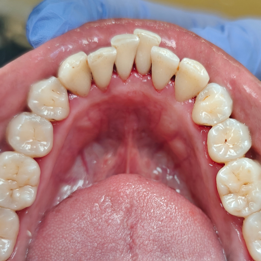 dental cleaning after e