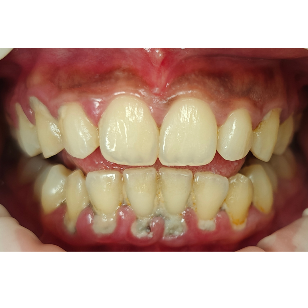 dental cleaning before c (2) dental cleaning before c (2)