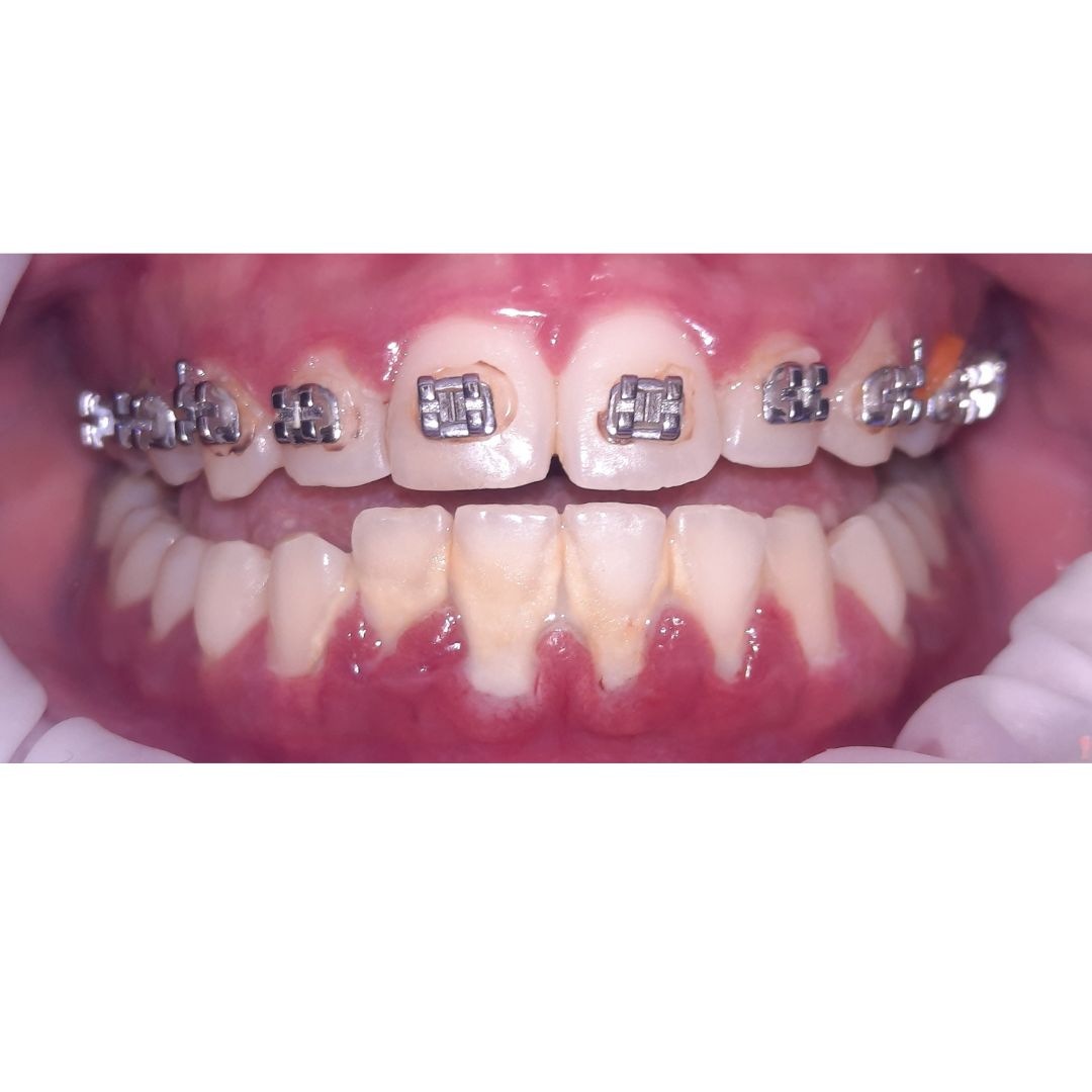 dental cleaning before d dental cleaning before d