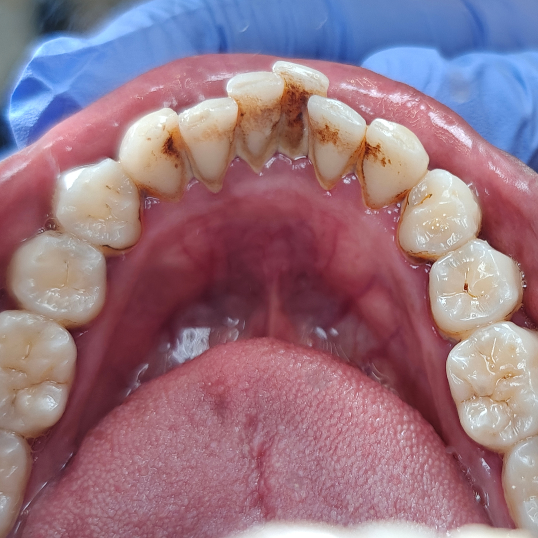 dental cleaning before e dental cleaning before e