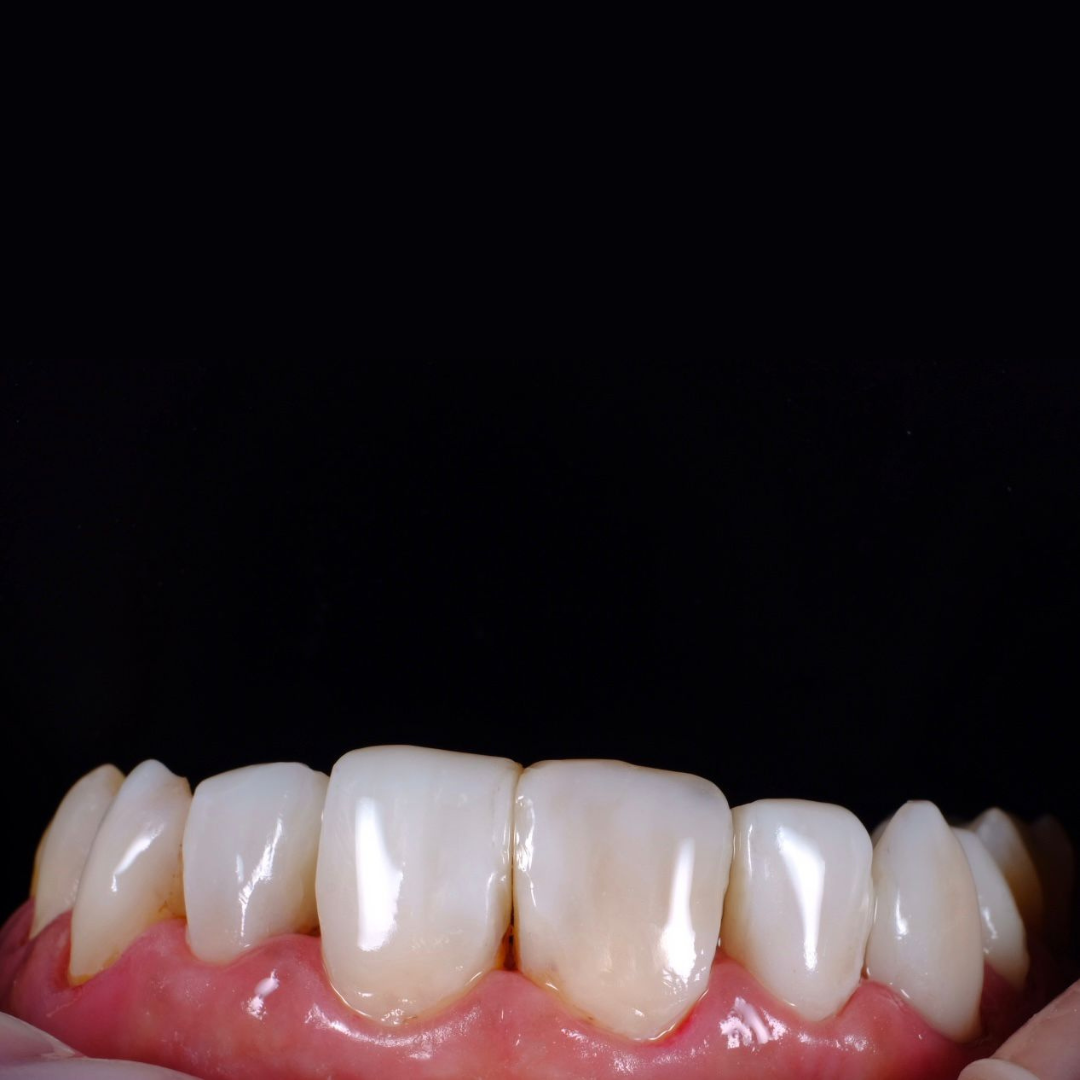 Veneer treatment at kanou dental