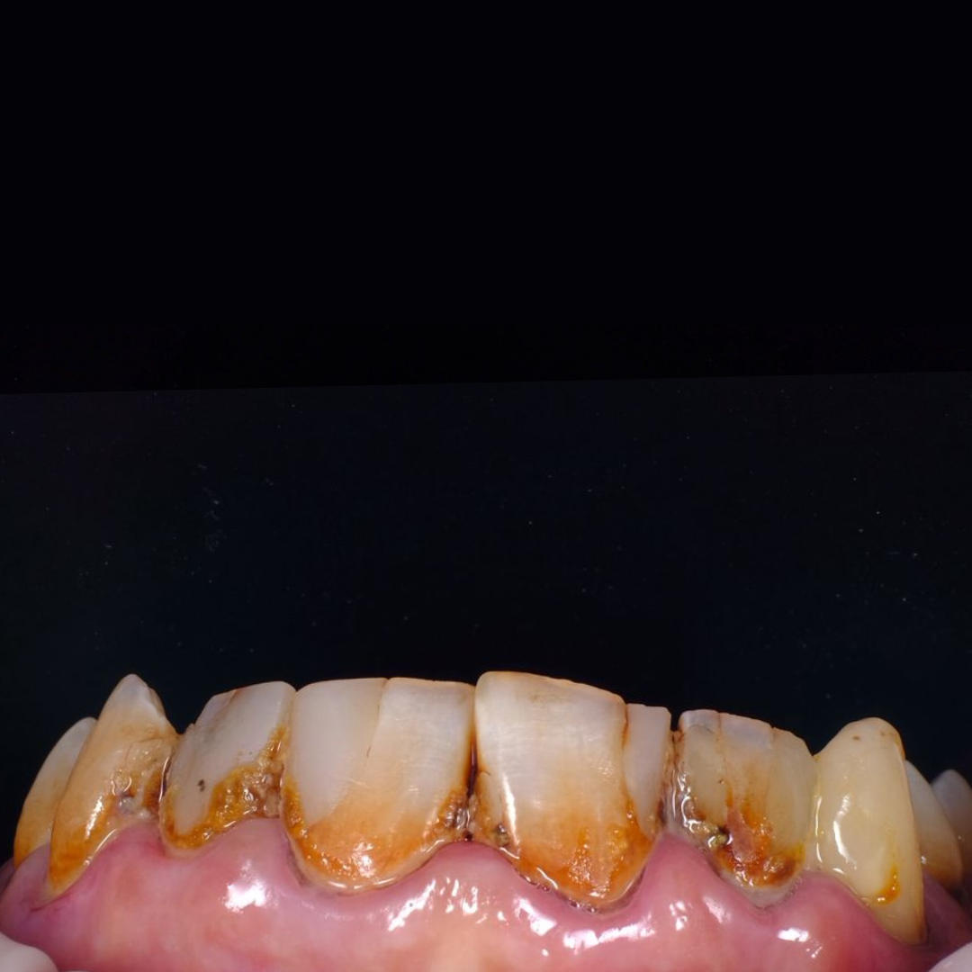 veneer after b Before Veneer treatment at kanou dental