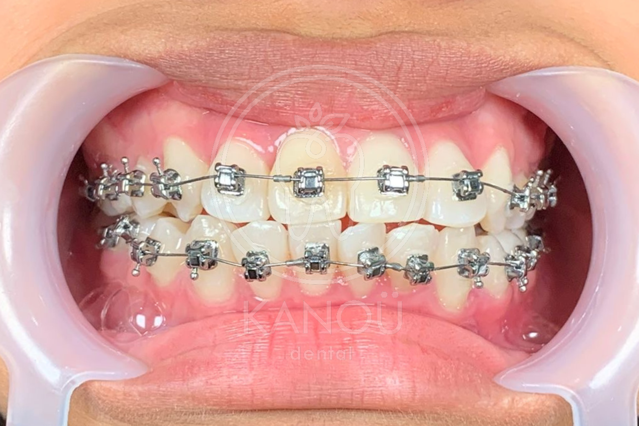 After Braces AN