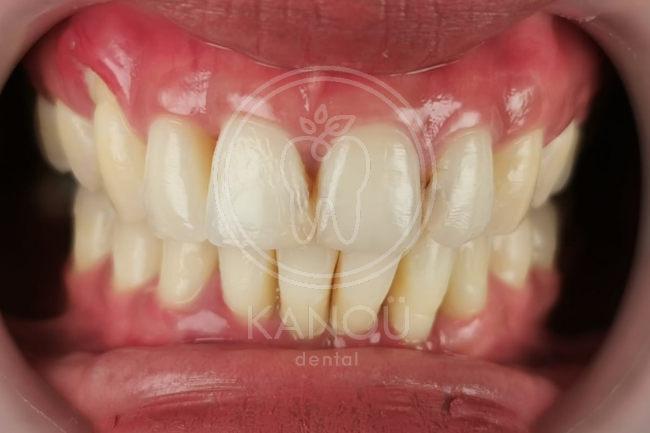 After Braces BN