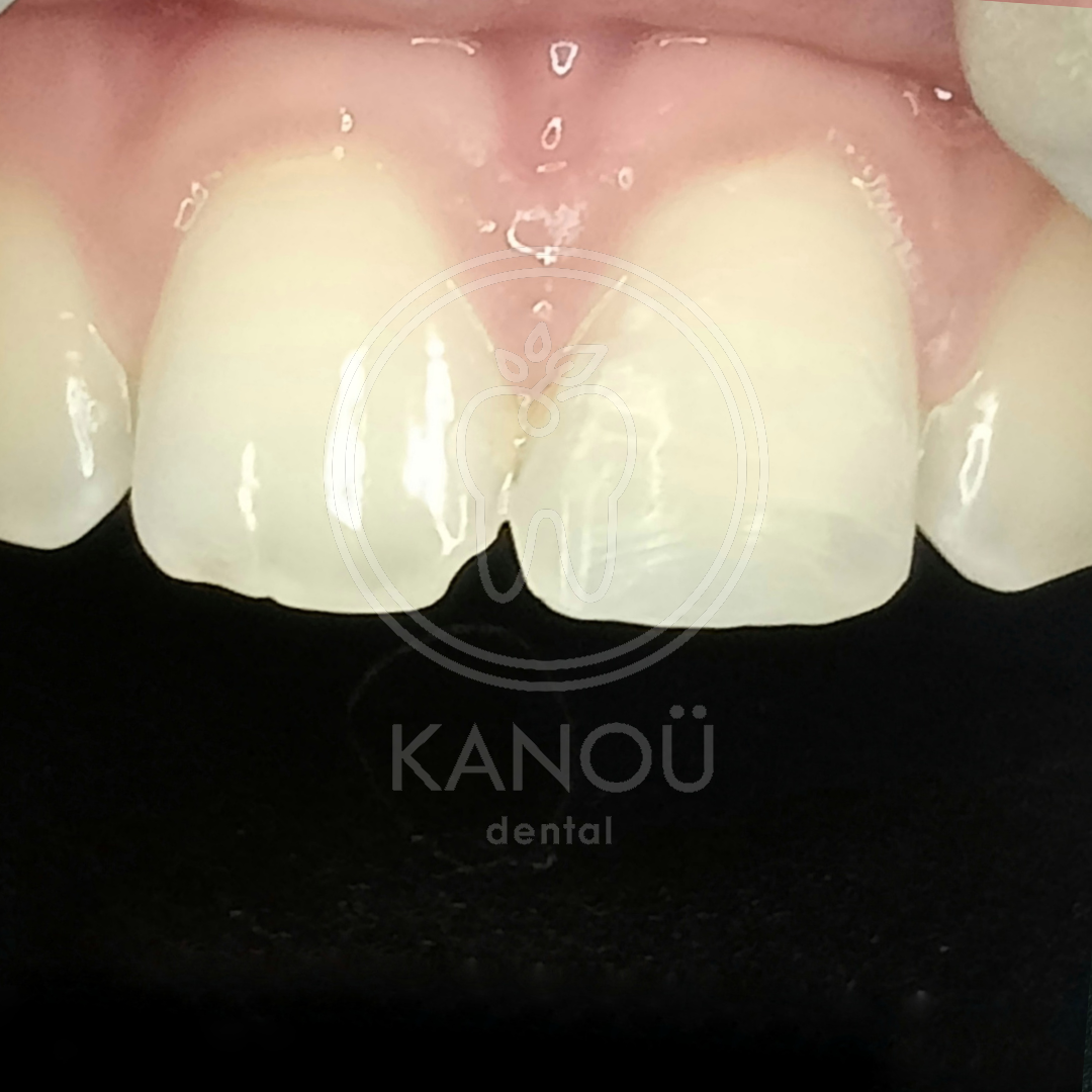 After Filling AN