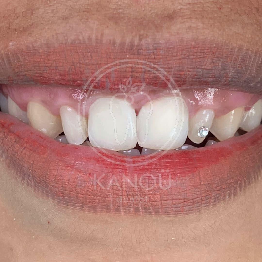 After Veneer direct A