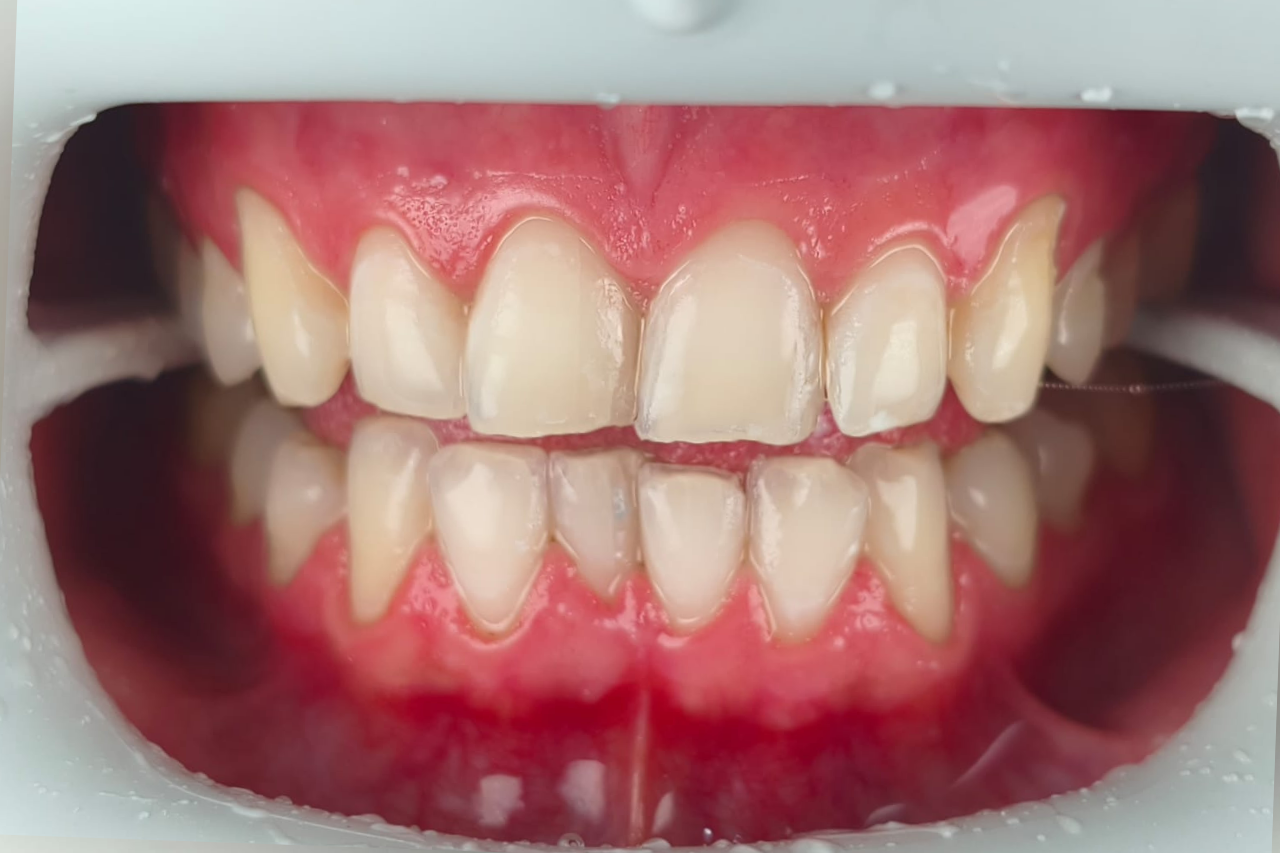 After Whitening Laser AN