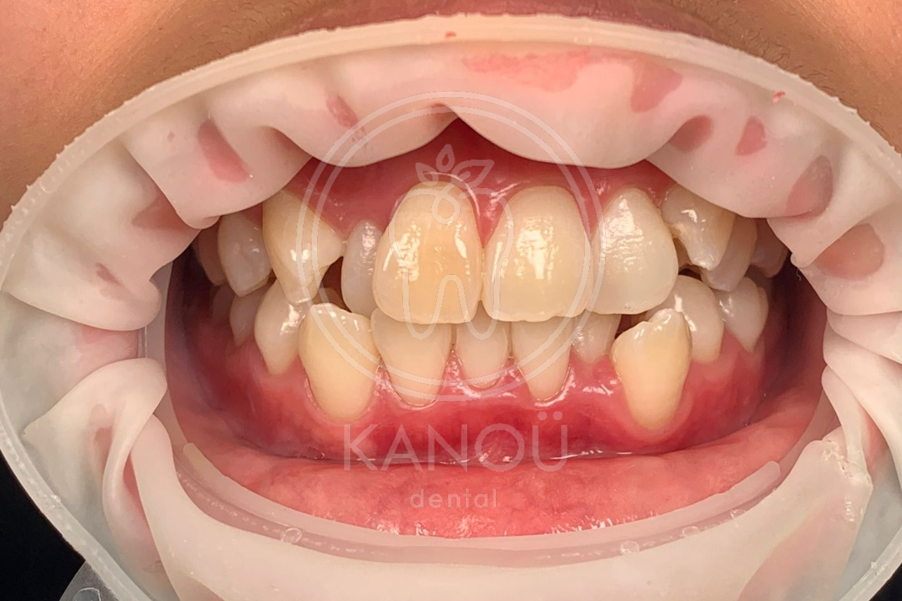 Before Braces AN Before Braces AN