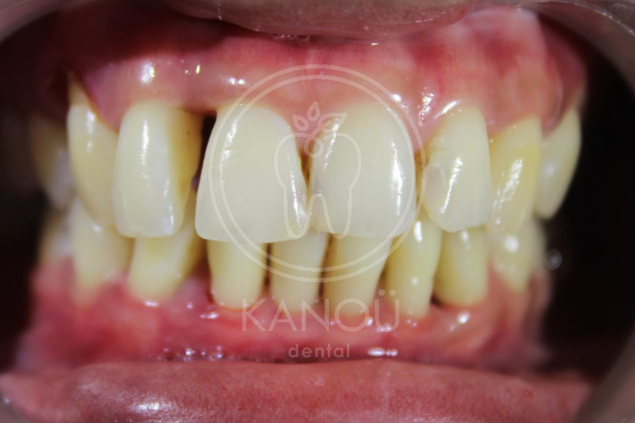 Before Braces BN Before Braces BN