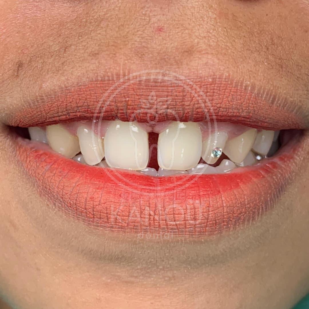 Before Veneer direct A Before Veneer direct A