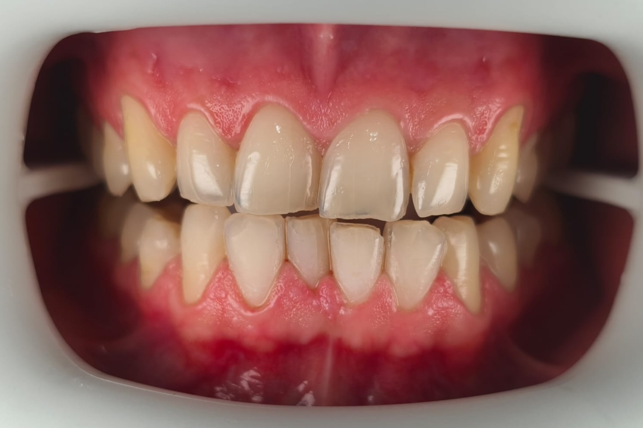 Before Whitening Laser AN Before Whitening Laser AN